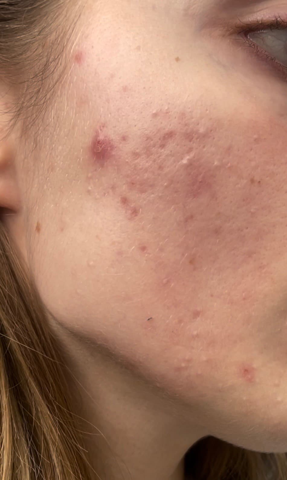 XVesuvius Wins Men's Health Award for Innovative Acne Treatment