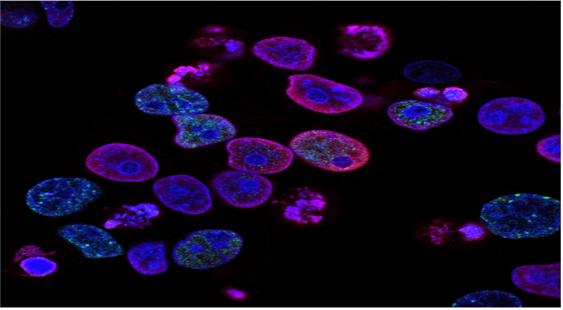 Promising Combination Therapy Offers New Hope for Advanced Prostate Cancer Patients