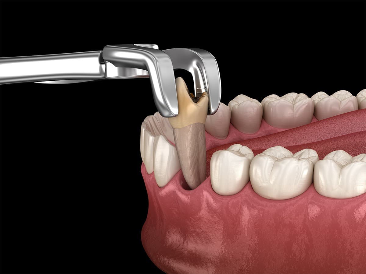 Sioux Falls Oral Surgery Practice Publishes Tooth Extraction Guide to Ease Patient Anxiety