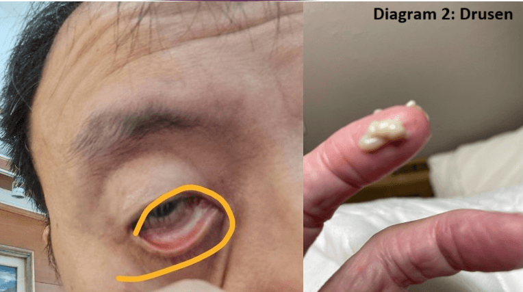 Lorati Company Unveils Nano-Grade Eye Drops for Age-Related Macular Degeneration Treatment