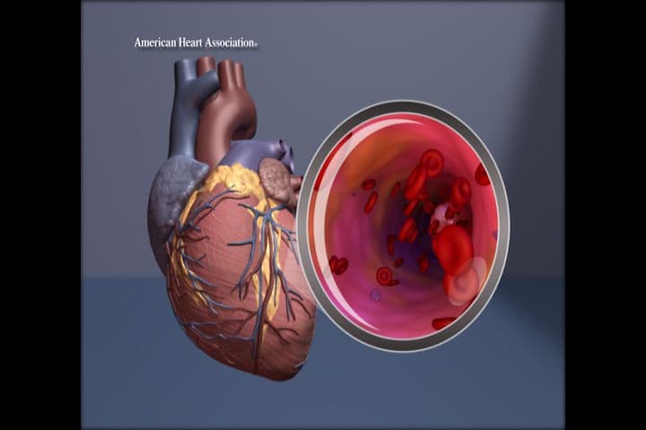MESA Heart Disease Risk Score Effective Without Race Factor, Study Finds
